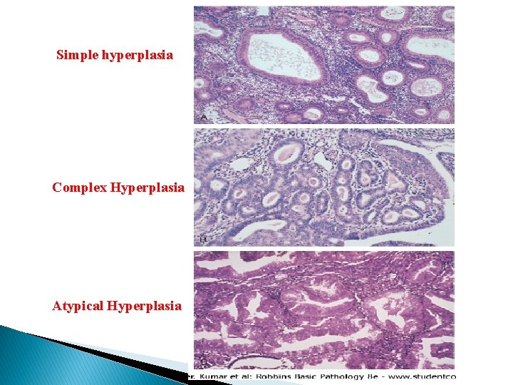 Simple hyperplasia Complex Hyperplasia Atypical Hyperplasia 