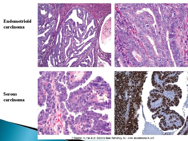 Endometrioid carcinoma Serous carcinoma 