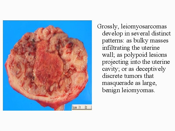 Grossly, leiomyosarcomas develop in several distinct patterns: as bulky masses infiltrating the uterine wall;