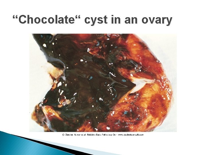 “Chocolate“ cyst in an ovary 