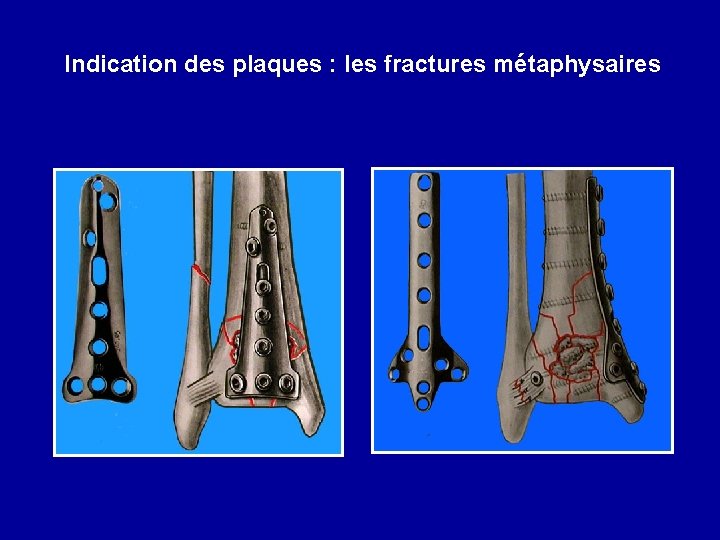 Indication des plaques : les fractures métaphysaires 