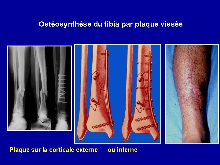 Ostéosynthèse du tibia par plaque vissée Plaque sur la corticale externe ou interne 