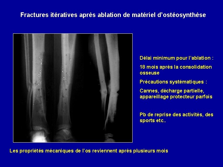 Fractures itératives après ablation de matériel d’ostéosynthèse Délai minimum pour l’ablation : 18 mois