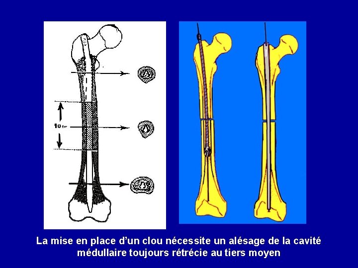 La mise en place d’un clou nécessite un alésage de la cavité médullaire toujours