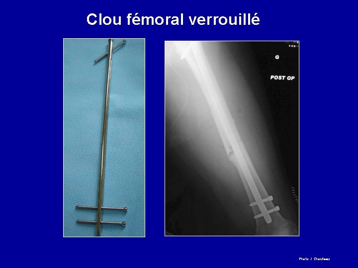 Clou fémoral verrouillé Photo J. Chouteau 