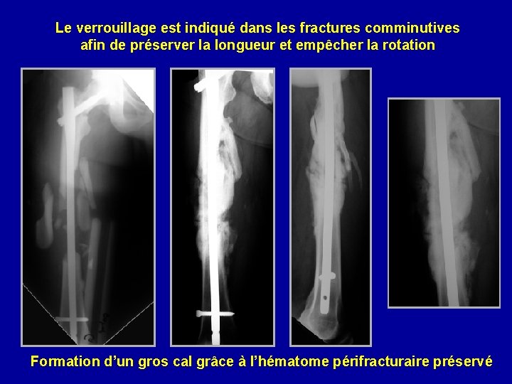 Le verrouillage est indiqué dans les fractures comminutives afin de préserver la longueur et