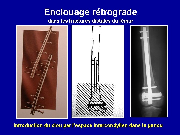 Enclouage rétrograde dans les fractures distales du fémur Introduction du clou par l’espace intercondylien