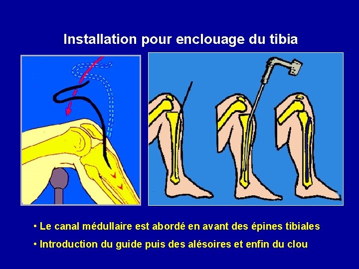 Installation pour enclouage du tibia • Le canal médullaire est abordé en avant des