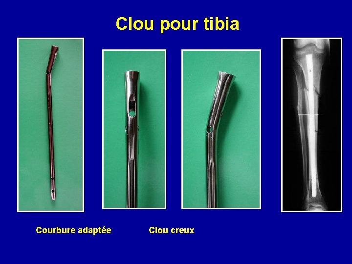 Clou pour tibia Courbure adaptée Clou creux 