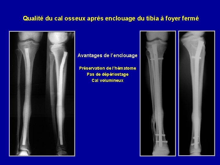 Qualité du cal osseux après enclouage du tibia à foyer fermé Avantages de l’enclouage