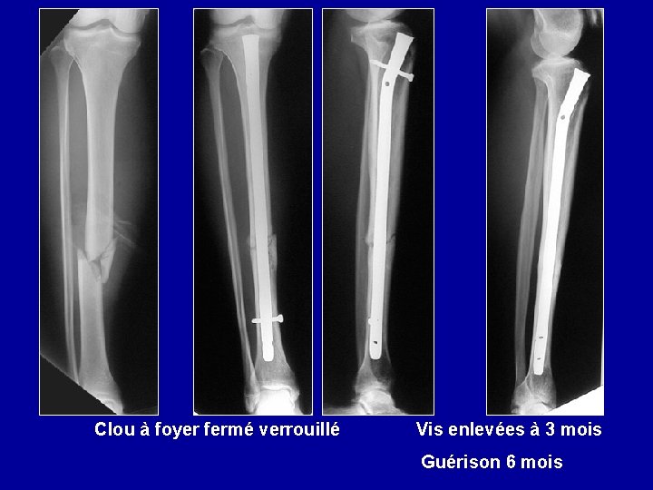  Clou à foyer fermé verrouillé Vis enlevées à 3 mois Guérison 6 mois