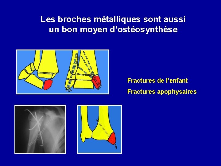 Les broches métalliques sont aussi un bon moyen d’ostéosynthèse Fractures de l’enfant Fractures apophysaires