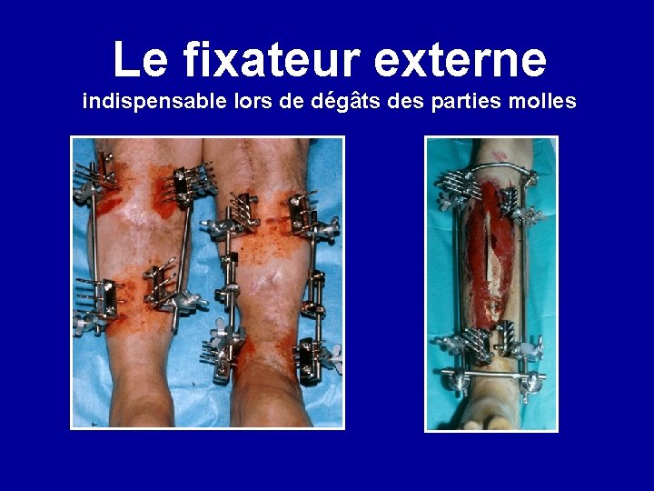 Le fixateur externe indispensable lors de dégâts des parties molles 