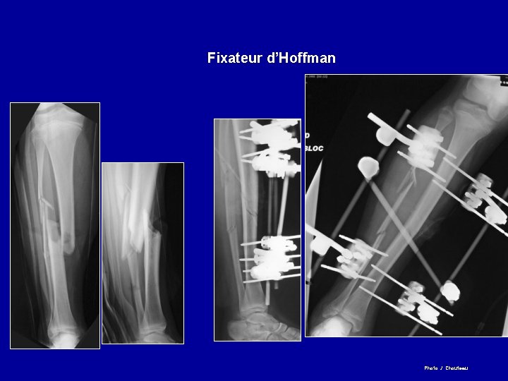 Fixateur d’Hoffman Photo J. Chouteau 