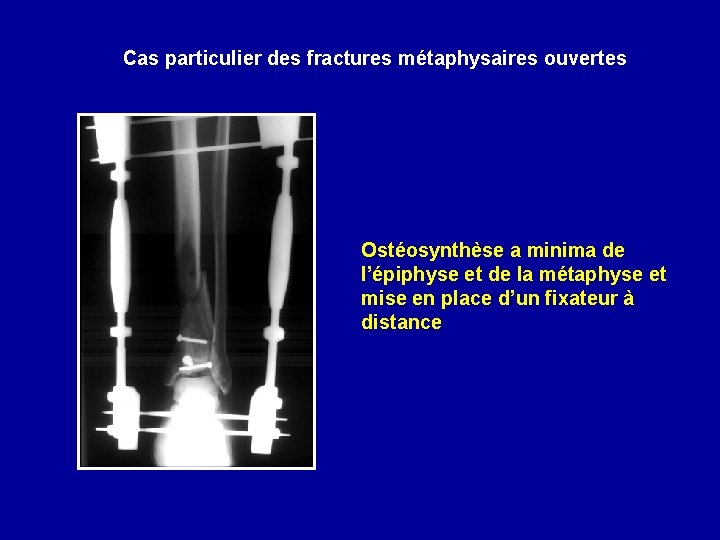 Cas particulier des fractures métaphysaires ouvertes Ostéosynthèse a minima de l’épiphyse et de la