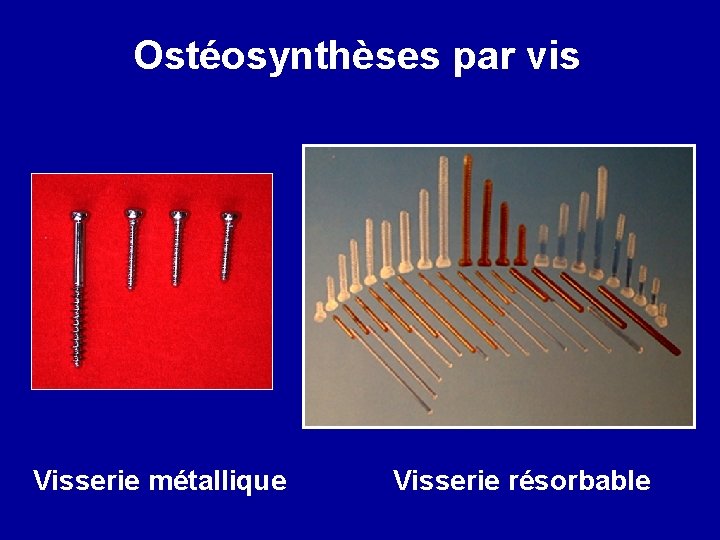 Ostéosynthèses par vis Visserie métallique Visserie résorbable 