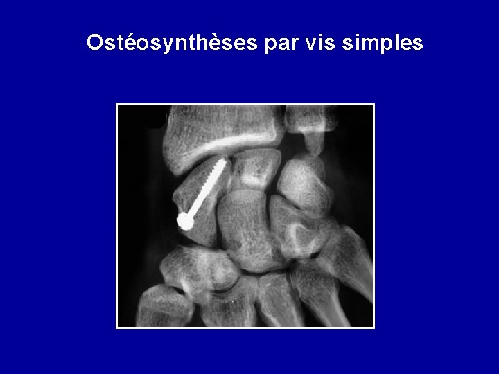 Ostéosynthèses par vis simples 