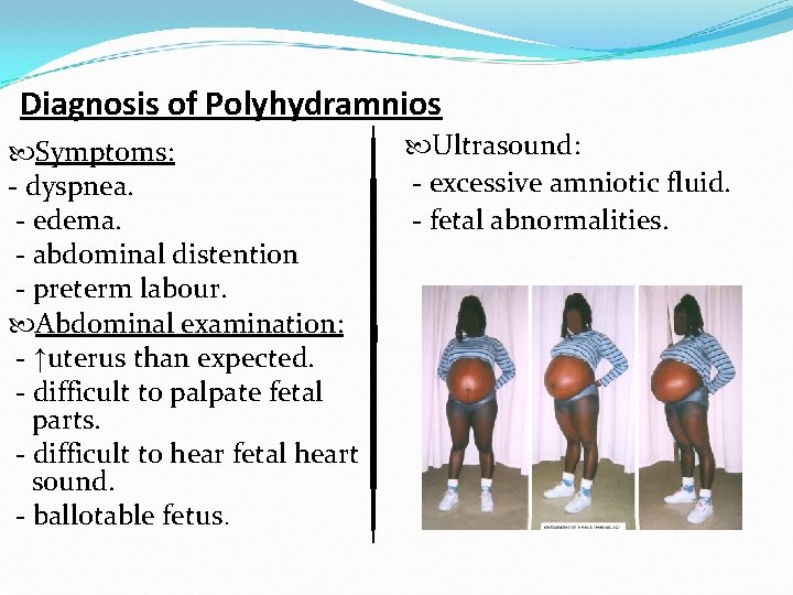 Diagnosis of Polyhydramnios Symptoms: - dyspnea. - edema. - abdominal distention - preterm labour.