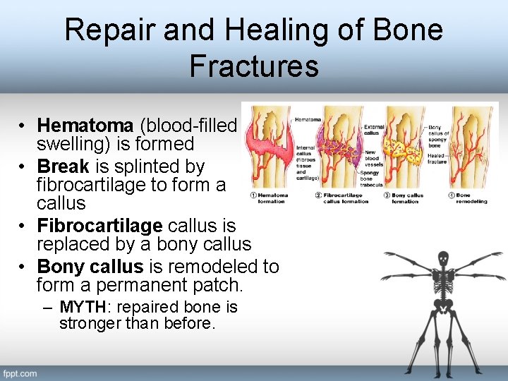 Repair and Healing of Bone Fractures • Hematoma (blood-filled swelling) is formed • Break