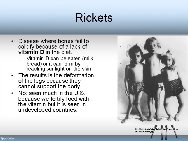 Rickets • Disease where bones fail to calcify because of a lack of vitamin