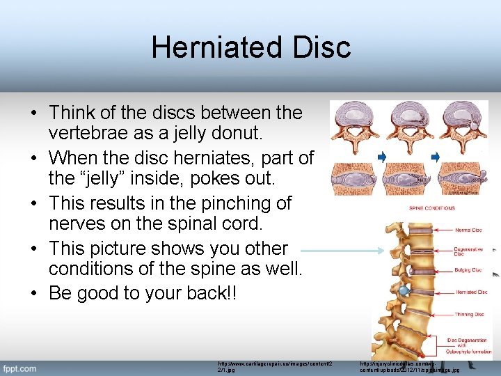 Herniated Disc • Think of the discs between the vertebrae as a jelly donut.