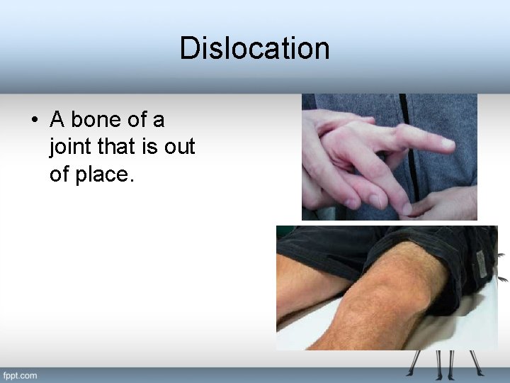 Dislocation • A bone of a joint that is out of place. 