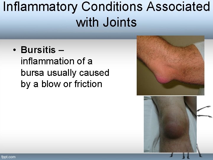 Inflammatory Conditions Associated with Joints • Bursitis – inflammation of a bursa usually caused