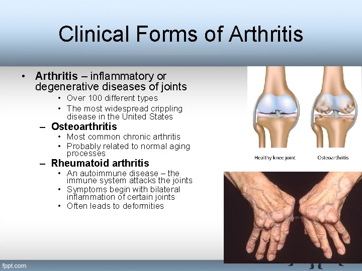 Clinical Forms of Arthritis • Arthritis – inflammatory or degenerative diseases of joints •