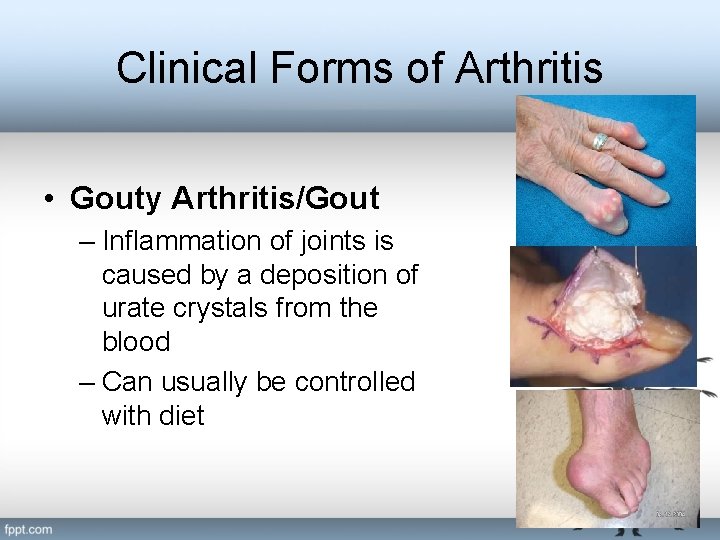 Clinical Forms of Arthritis • Gouty Arthritis/Gout – Inflammation of joints is caused by