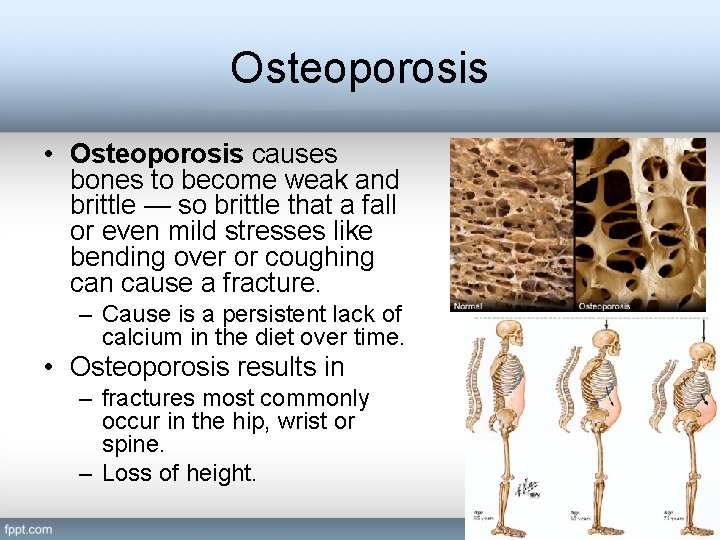 Osteoporosis • Osteoporosis causes bones to become weak and brittle — so brittle that