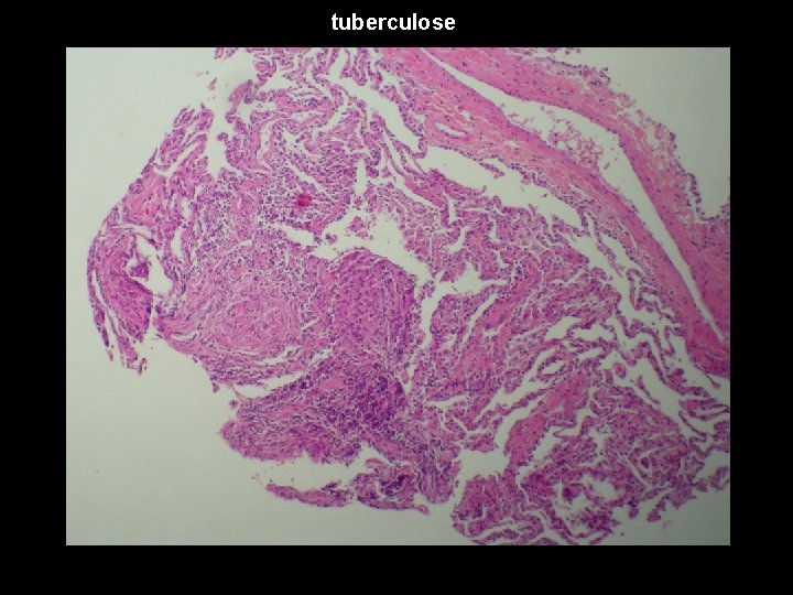 tuberculose 