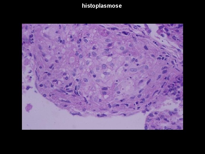 histoplasmose 