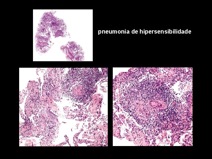 pneumonia de hipersensibilidade 