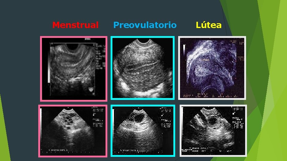 Menstrual Preovulatorio Lútea 
