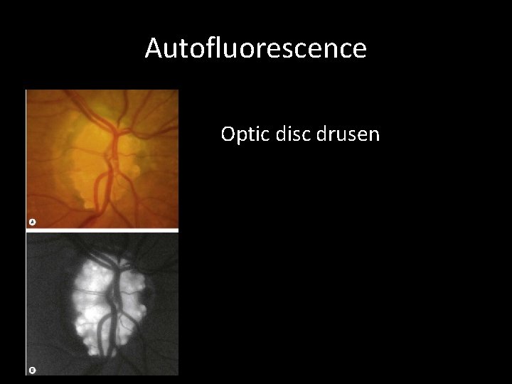 Autofluorescence Optic disc drusen 