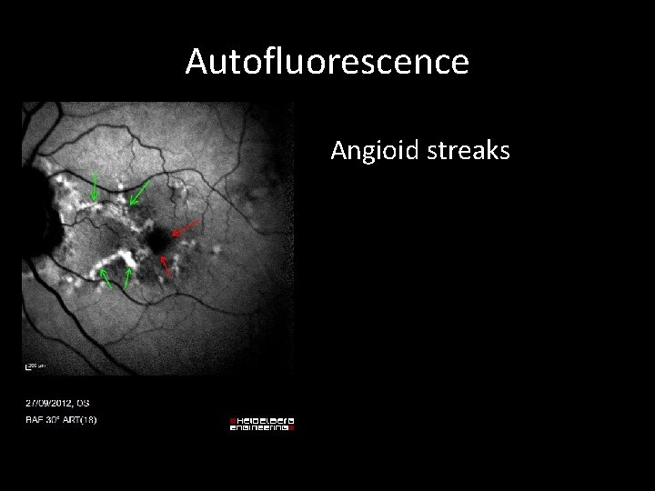 Autofluorescence Angioid streaks 