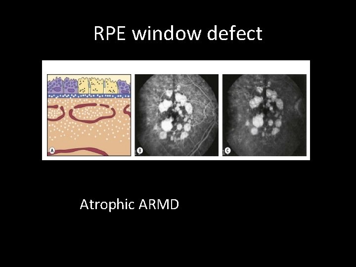 RPE window defect Atrophic ARMD 