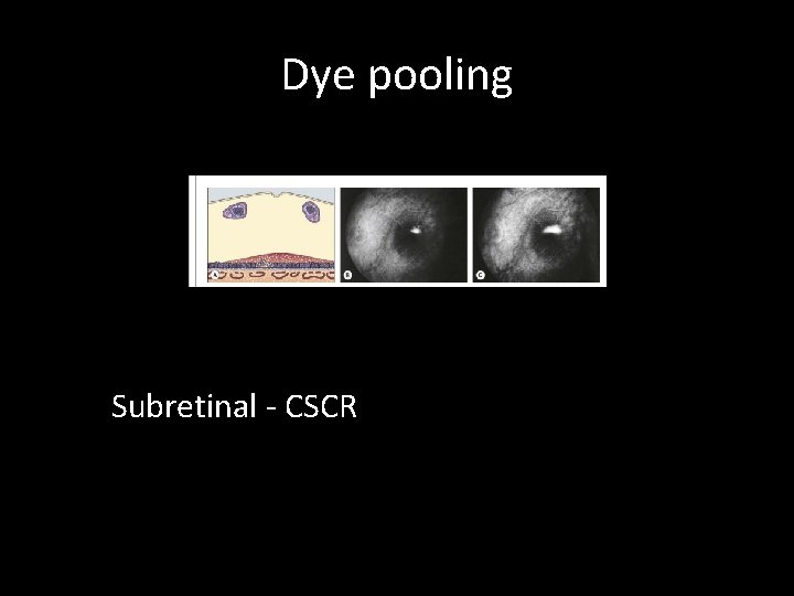 Dye pooling Subretinal - CSCR 