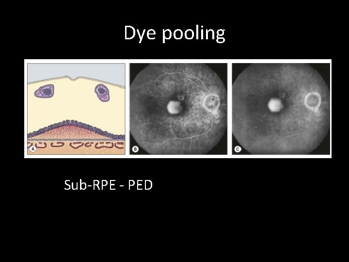 Dye pooling Sub-RPE - PED 