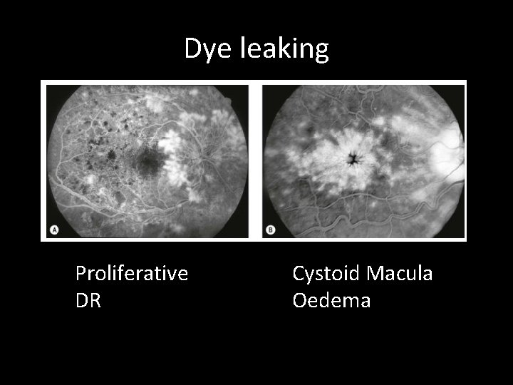 Dye leaking Proliferative DR Cystoid Macula Oedema 