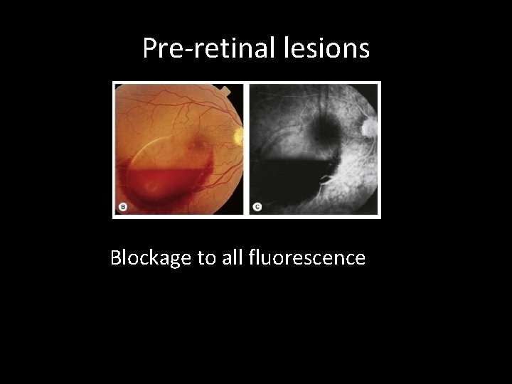 Pre-retinal lesions Blockage to all fluorescence 