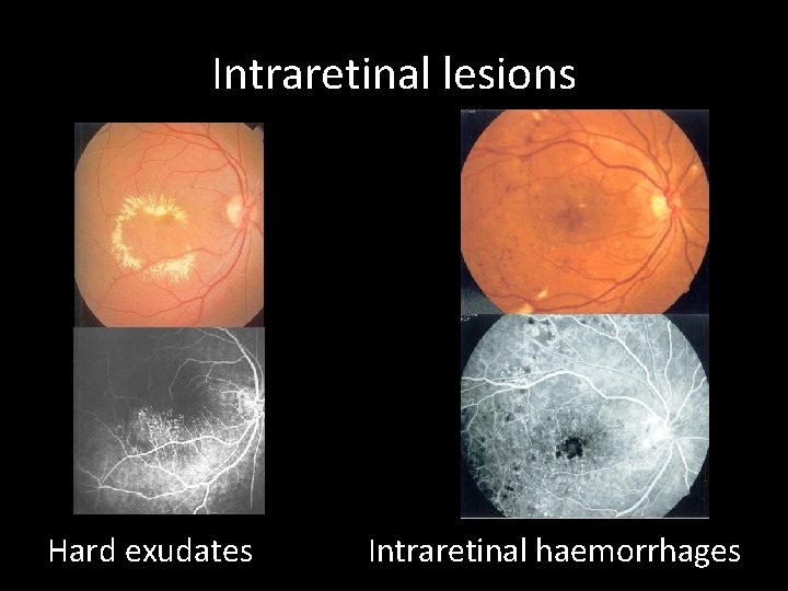 Intraretinal lesions Hard exudates Intraretinal haemorrhages 