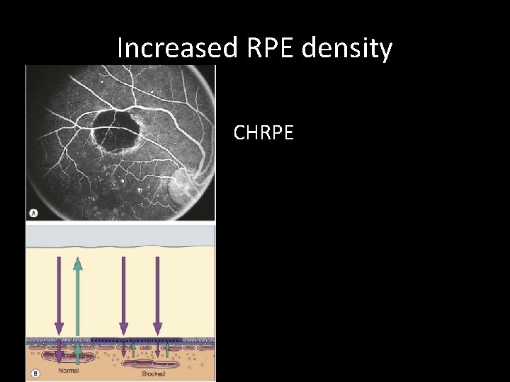 Increased RPE density CHRPE 