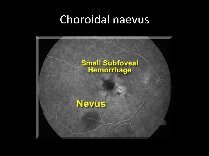 Choroidal naevus 