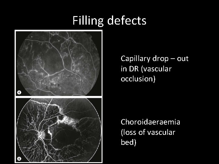 Filling defects Capillary drop – out in DR (vascular occlusion) Choroidaeraemia (loss of vascular