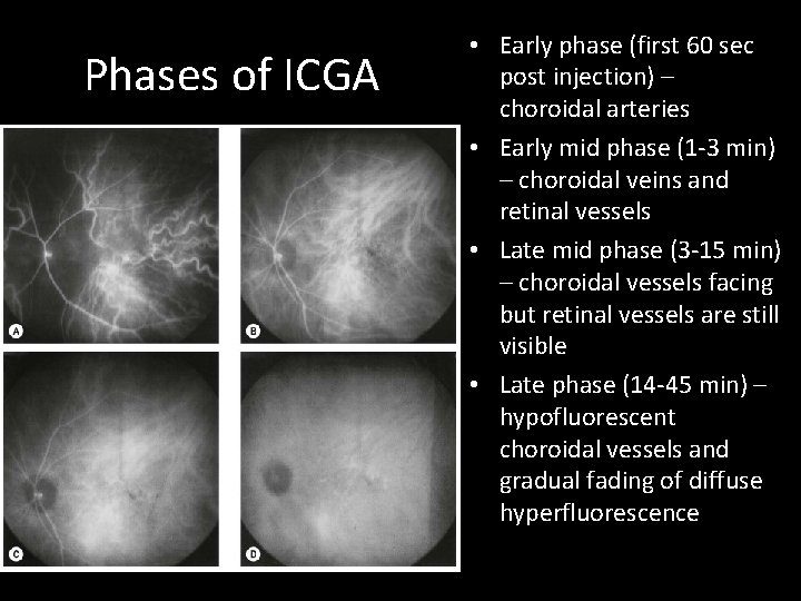 Phases of ICGA • Early phase (first 60 sec post injection) – choroidal arteries