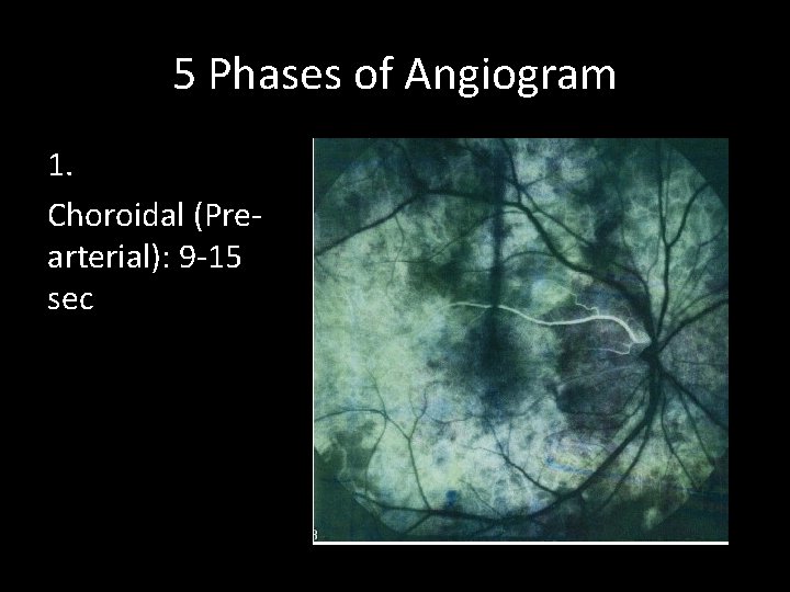 5 Phases of Angiogram 1. Choroidal (Prearterial): 9 -15 sec 