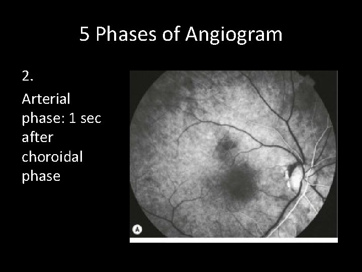 5 Phases of Angiogram 2. Arterial phase: 1 sec after choroidal phase 