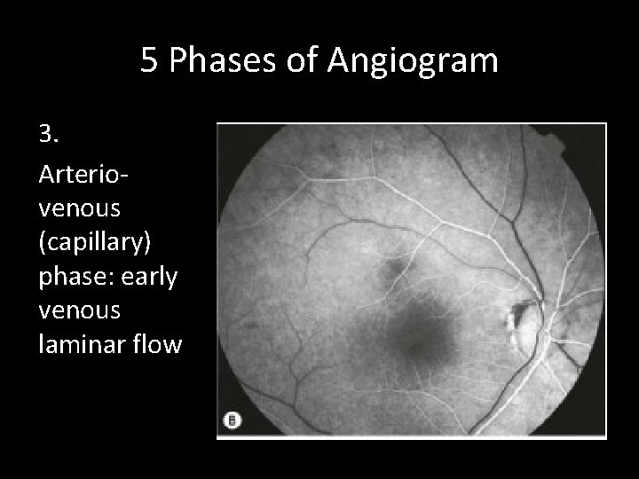 5 Phases of Angiogram 3. Arteriovenous (capillary) phase: early venous laminar flow 