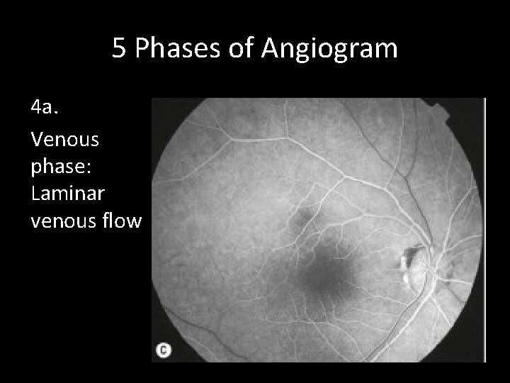 5 Phases of Angiogram 4 a. Venous phase: Laminar venous flow 